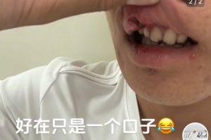 玉昆后衛(wèi)曬受傷照：提前換下因爭頭球撞到了 視野模糊看不清&頭暈