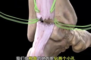 看著都疼啊科普帖：球員腳跟腱斷裂是如何進(jìn)行修復(fù)的？